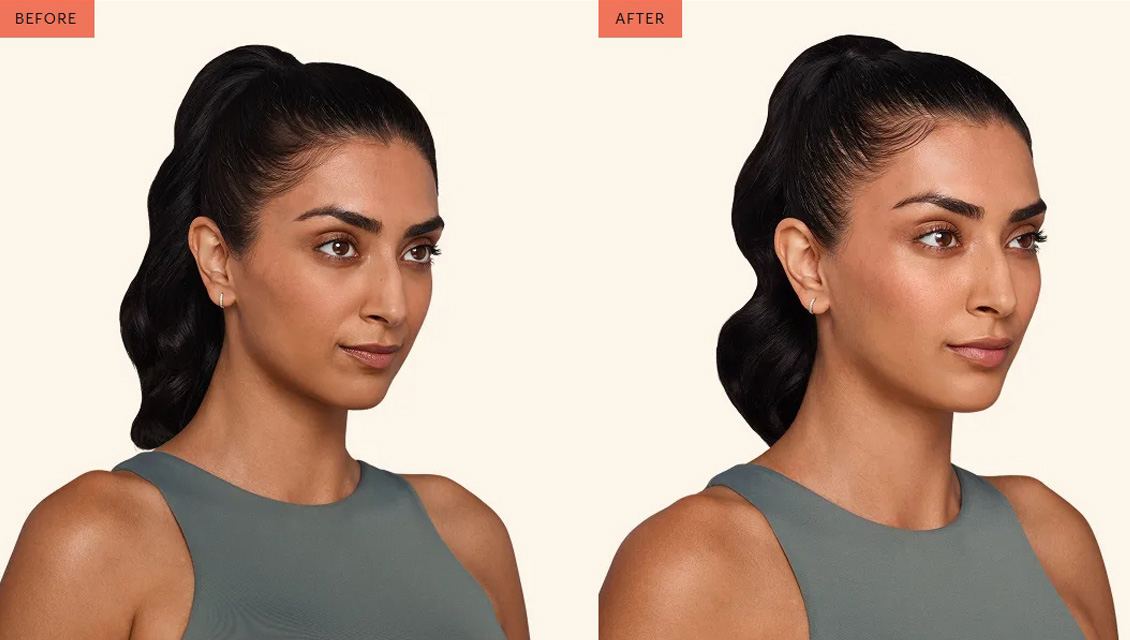juvederm-before-after-1