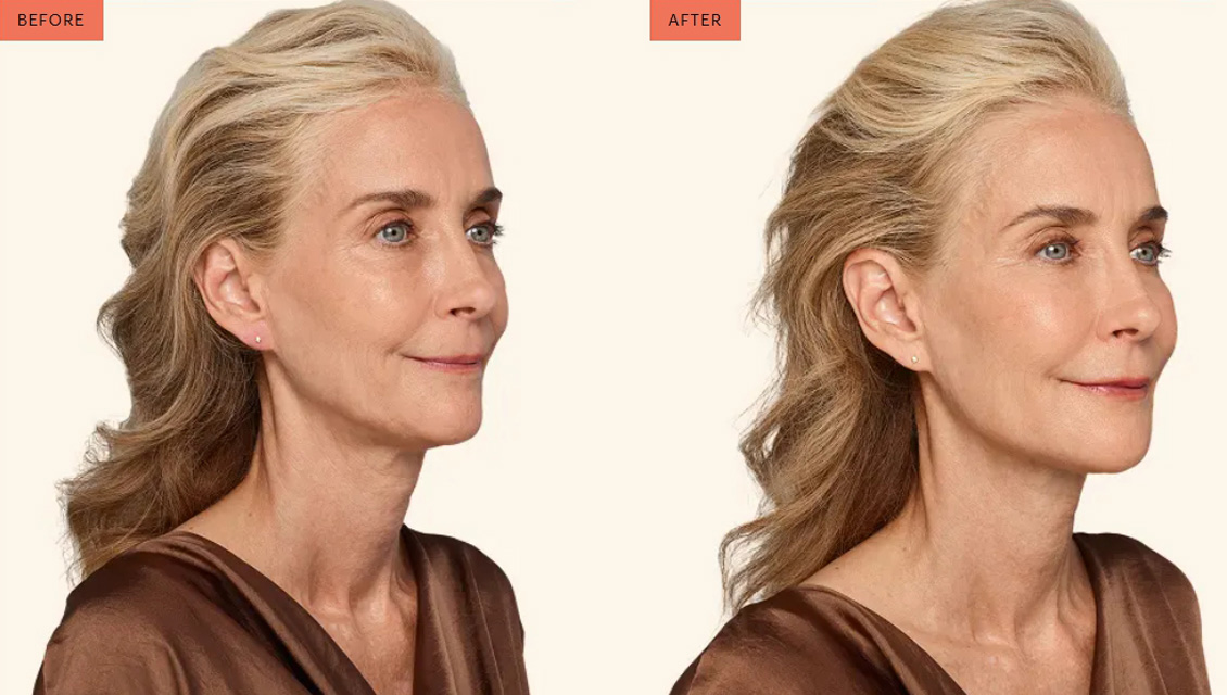 juvederm-before-after-2