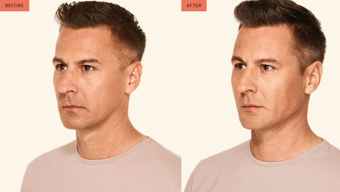 juvederm-before-after-3