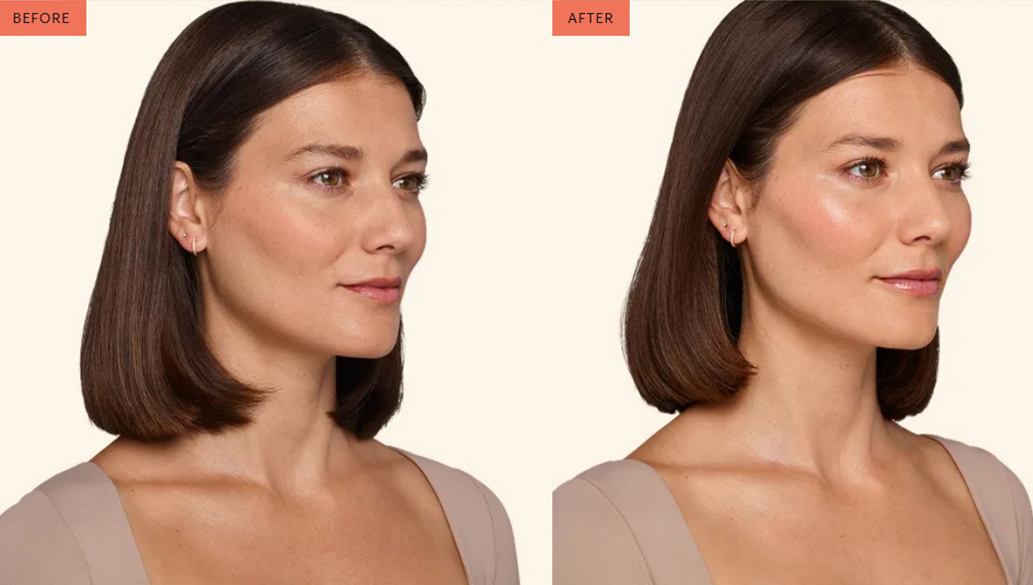 juvederm-before-after-4